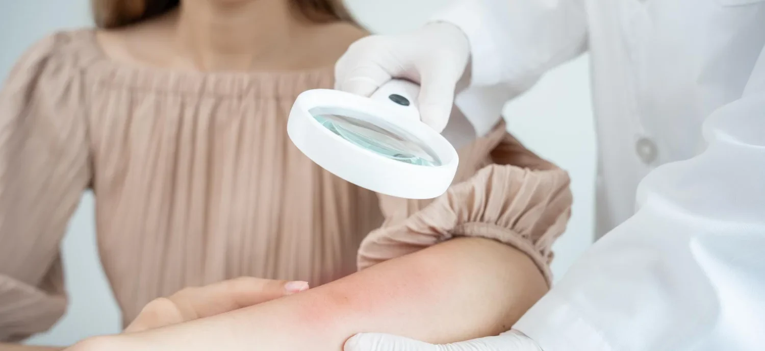 How Long Do Hives Last? / What Are Hives? / How Long Do Hives Usually Last? / Acute Hives / Chronic Hives / How Long Does Each Individual Hive Last? / What Affects How Long Hives Last? / The Cause of the Hives / Your Immune System / Medications or Treatment / Stress and Emotional Factors / Can You Speed Up the Healing of Hives? /When Should You See a Doctor? / What Is the Outlook for People With Hives? / Can Hives Come Back After They Go Away? / Can Hives Last for Months or Years? / Palm Beach Dermatology Beach / PGA Dermatology