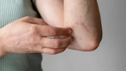 What Causes Hives? Everything You Need To Know / What Are Hives? / The Different Types of Hives / What Causes Hives? The Most Common Triggers / Allergic Reactions / Infections / Environmental Triggers / Stress / Physical Activity / Underlying Health Conditions / Unknown Causes / How Hives Develop in the Body / Symptoms That Accompany Hives / When to See a Doctor / How to Prevent Hives / Treatment Options for Hives / FAQs About Hives / Palm Beach Dermatology Group / PGA Dermatology