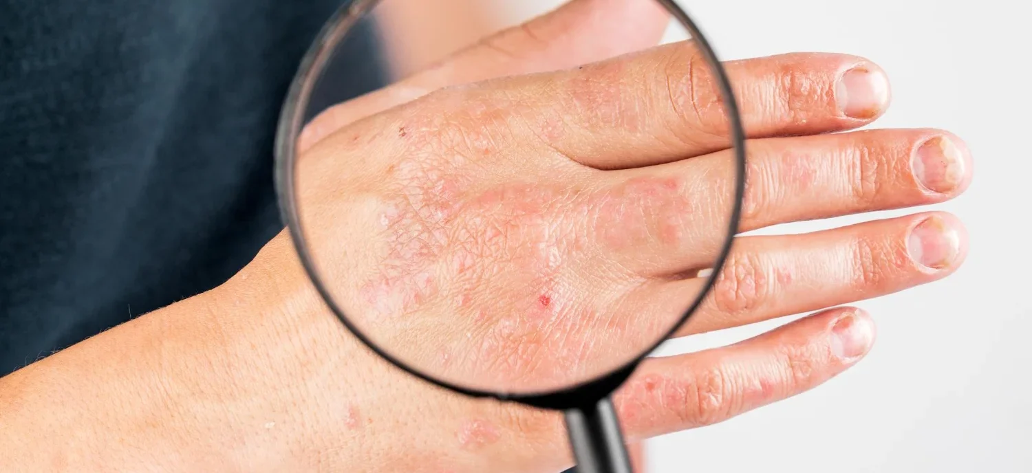 What Causes Hives? Everything You Need To Know / What Are Hives? / The Different Types of Hives / What Causes Hives? The Most Common Triggers / Allergic Reactions / Infections / Environmental Triggers / Stress / Physical Activity / Underlying Health Conditions / Unknown Causes / How Hives Develop in the Body / Symptoms That Accompany Hives / When to See a Doctor / How to Prevent Hives / Treatment Options for Hives / FAQs About Hives / Palm Beach Dermatology Group / PGA Dermatology