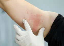 What Are Hives? Causes, Diagnosis, Types & Treatment / What Are Hives? / What Do Hives Look Like? / What Causes Hives? / How Are Hives Diagnosed? / Are Hives Dangerous? / How Are Hives Treated? / What About Home Remedies? / What If Hives Keep Coming Back? / Managing Chronic Hives / Can Hives Be Prevented? / Are There Long-Term Effects of Hives? / When to See a Doctor / Rare and Unusual Types of Hives / Common Myths About Hives / Hives vs. Other Skin Conditions / FAQs On What Are Hives / Palm Beach Dermatology Group / PGA Dermatology