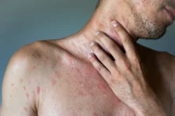 What Are Hives? Causes, Diagnosis, Types & Treatment / What Are Hives? / What Do Hives Look Like? / What Causes Hives? / How Are Hives Diagnosed? / Are Hives Dangerous? / How Are Hives Treated? / What About Home Remedies? / What If Hives Keep Coming Back? / Managing Chronic Hives / Can Hives Be Prevented? / Are There Long-Term Effects of Hives? / When to See a Doctor / Rare and Unusual Types of Hives / Common Myths About Hives / Hives vs. Other Skin Conditions / FAQs On What Are Hives / Palm Beach Dermatology Group / PGA Dermatology