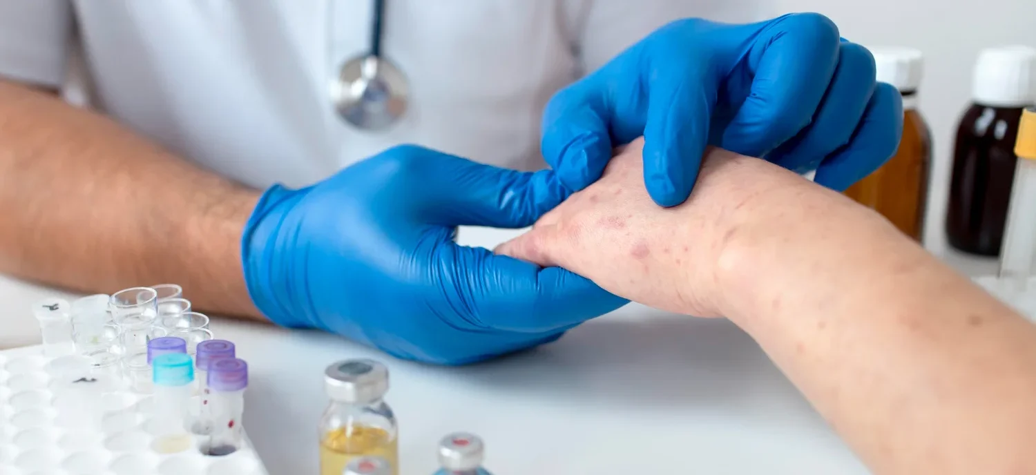 What Are Hives? Causes, Diagnosis, Types & Treatment / What Are Hives? / What Do Hives Look Like? / What Causes Hives? / How Are Hives Diagnosed? / Are Hives Dangerous? / How Are Hives Treated? / What About Home Remedies? / What If Hives Keep Coming Back? / Managing Chronic Hives / Can Hives Be Prevented? / Are There Long-Term Effects of Hives? / When to See a Doctor / Rare and Unusual Types of Hives / Common Myths About Hives / Hives vs. Other Skin Conditions / FAQs On What Are Hives / Palm Beach Dermatology Group / PGA Dermatology