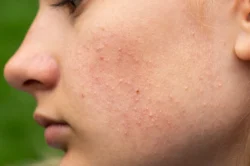 Do Whiteheads Disappear on Their Own? Causes and Treatment / What Exactly Are Whiteheads? / Do Whiteheads Disappear on Their Own? / Risks of Waiting for Whiteheads to Go Away / Safe Ways to Help Whiteheads Clear Faster / What You Should Not Do / Preventing Whiteheads in the First Place / When to See a Dermatologist / Palm Beach Dermatology Group / PGA Dermatology