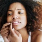 When her skin has acne - Do Whiteheads Disappear on Their Own? Causes and Treatment / What Exactly Are Whiteheads? / Do Whiteheads Disappear on Their Own? / Risks of Waiting for Whiteheads to Go Away / Safe Ways to Help Whiteheads Clear Faster / What You Should Not Do / Preventing Whiteheads in the First Place / When to See a Dermatologist / Palm Beach Dermatology Group / PGA Dermatology