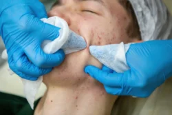 A young Caucasian teenage boy has a cosmetologist cleaning his face. A dermatologist treats acne - How to Prevent Blackheads: A Complete Guide - Palm Beach Dermatology Group
