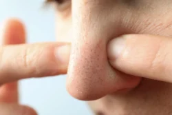 Concept of skin care with nose with dots - How to Get Rid of Blackheads on Nose and Ears - Palm Beach Dermatology Group - PGA Dermatology