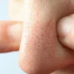 Concept of skin care with nose with dots - How to Get Rid of Blackheads on Nose and Ears - Palm Beach Dermatology Group - PGA Dermatology