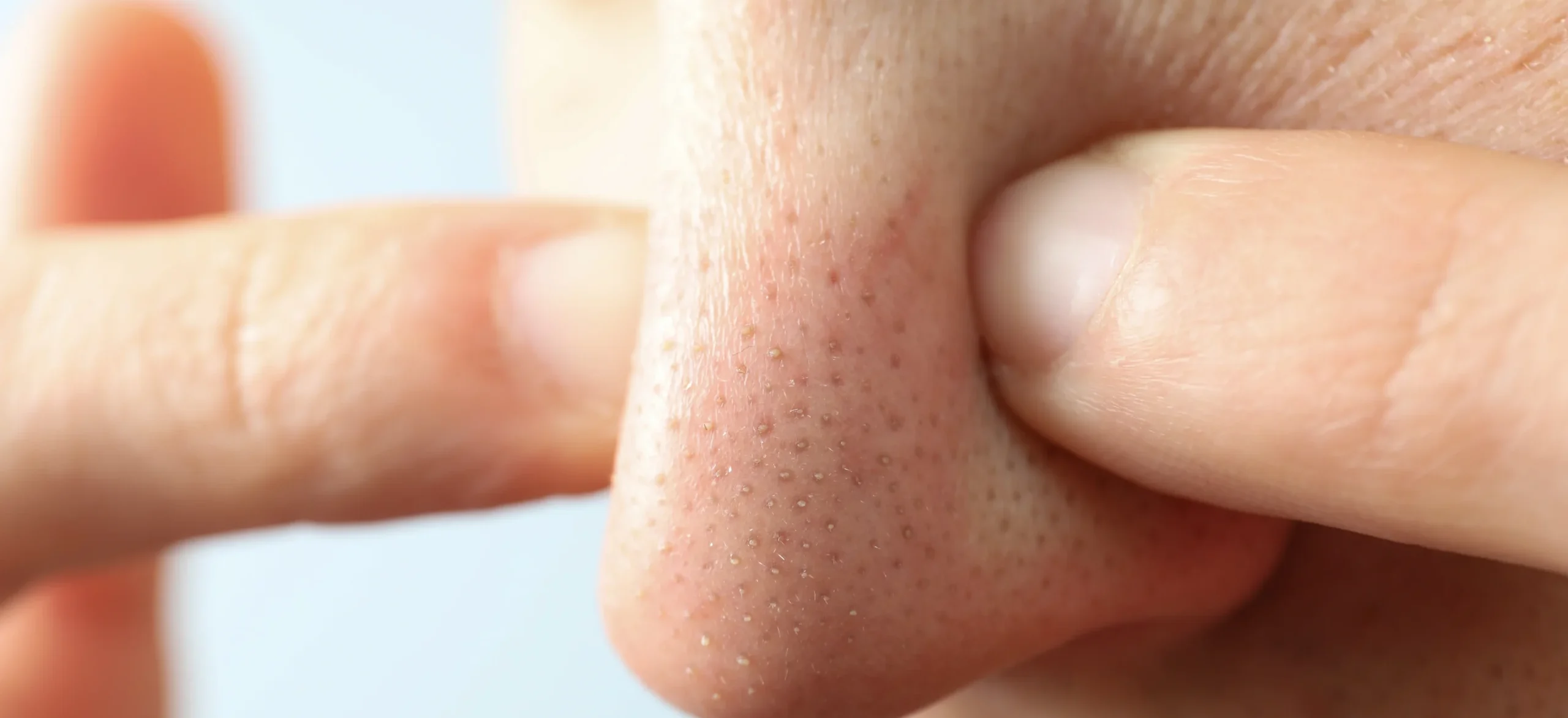 Concept of skin care with nose with dots - How to Get Rid of Blackheads on Nose and Ears - Palm Beach Dermatology Group - PGA Dermatology