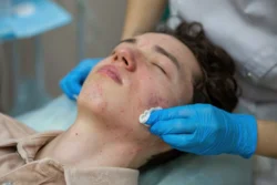 Treatment of acne in adolescents facial peeling - What Causes Blackheads? Prevention & Treatment - Palm Beach Dermatology Group