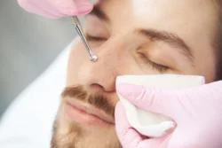 Uno spoon pressed to male nose during pores removal treatment - What Are Blackheads? Causes, Removal & Prevention - Palm Beach Dermatology Group
