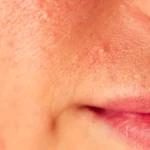 post-acne, scars and red festering pimples on the face of a young woman. - How to Get Rid of Fungal Acne? - Palm Beach Dermatology Group in Florida - PGA Dermatolgoy