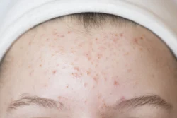 Problematic skin. Acne and red festering pimples on the face of a young girl . - How to Get Rid of Fungal Acne? - Palm Beach Dermatology Group in Florida - PGA Dermatolgoy