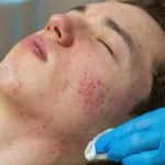 Treatment of acne in adolescents. Facial peeling to fight acne on the face - Fungal Acne - Causes, Diagnosis & Treatment - Palm Beach Dermatology Group - PGA Dermatology