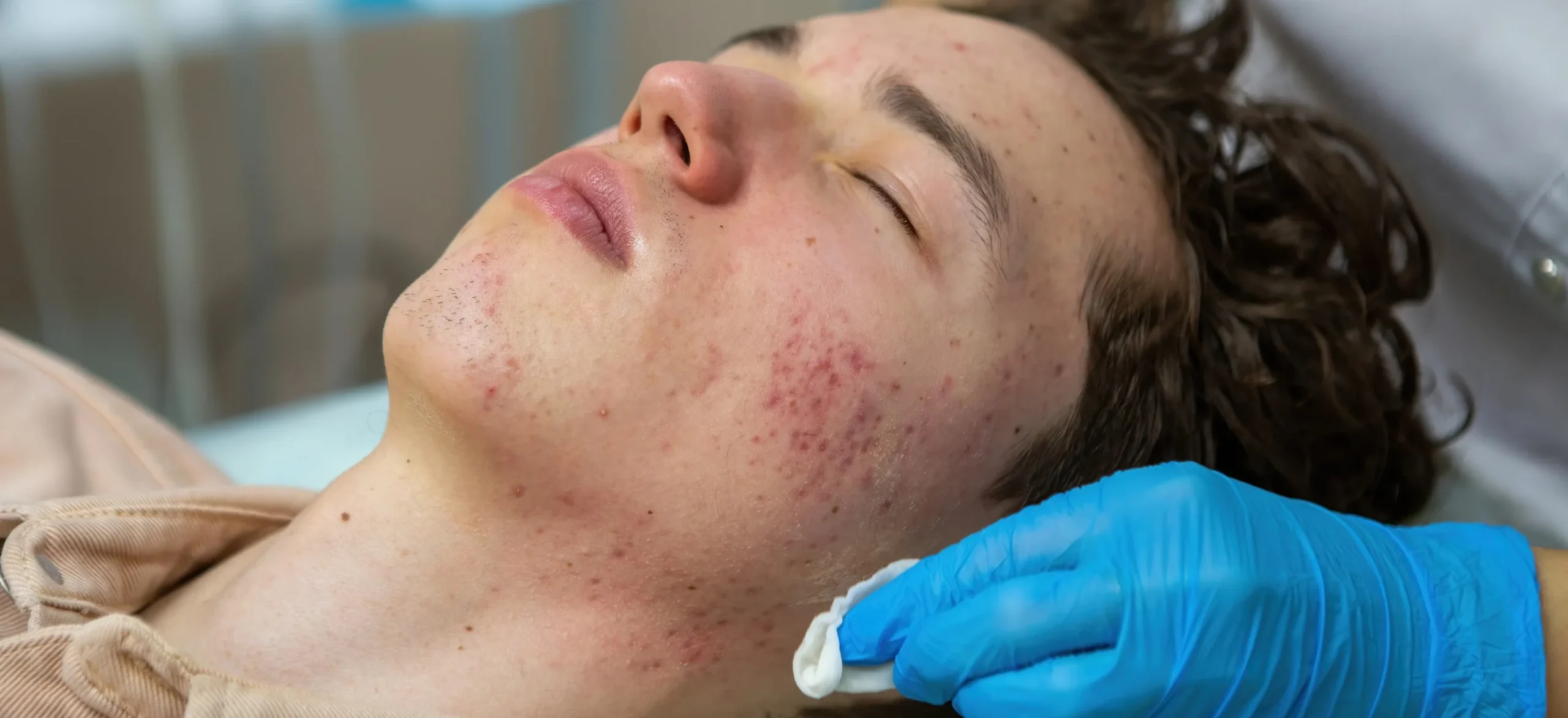 Treatment of acne in adolescents. Facial peeling to fight acne on the face - Fungal Acne - Causes, Diagnosis & Treatment - Palm Beach Dermatology Group - PGA Dermatology