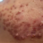 Acne on face because the disorders of sebaceous glands productions. Acne or a Cosmetic - What Causes Fungal Acne? A Simple Guide - Palm Beach Dermatology Group - PGA Dermatology