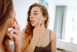 Beautiful woman with acne problem skin checks dry face skin. Red spots, rash, acne. Skin treatment. - What Causes Fungal Acne? A Simple Guide - Palm Beach Dermatology Group - PGA Dermatology