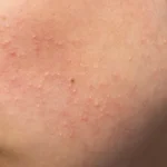 Is fungal acne contagious? - Palm Beach Dermatology Group