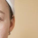 Teen girl with acne problem - Hormonal Acne - A Complete Guide - Palm Beach Dermatology Group - PGA Dermatology