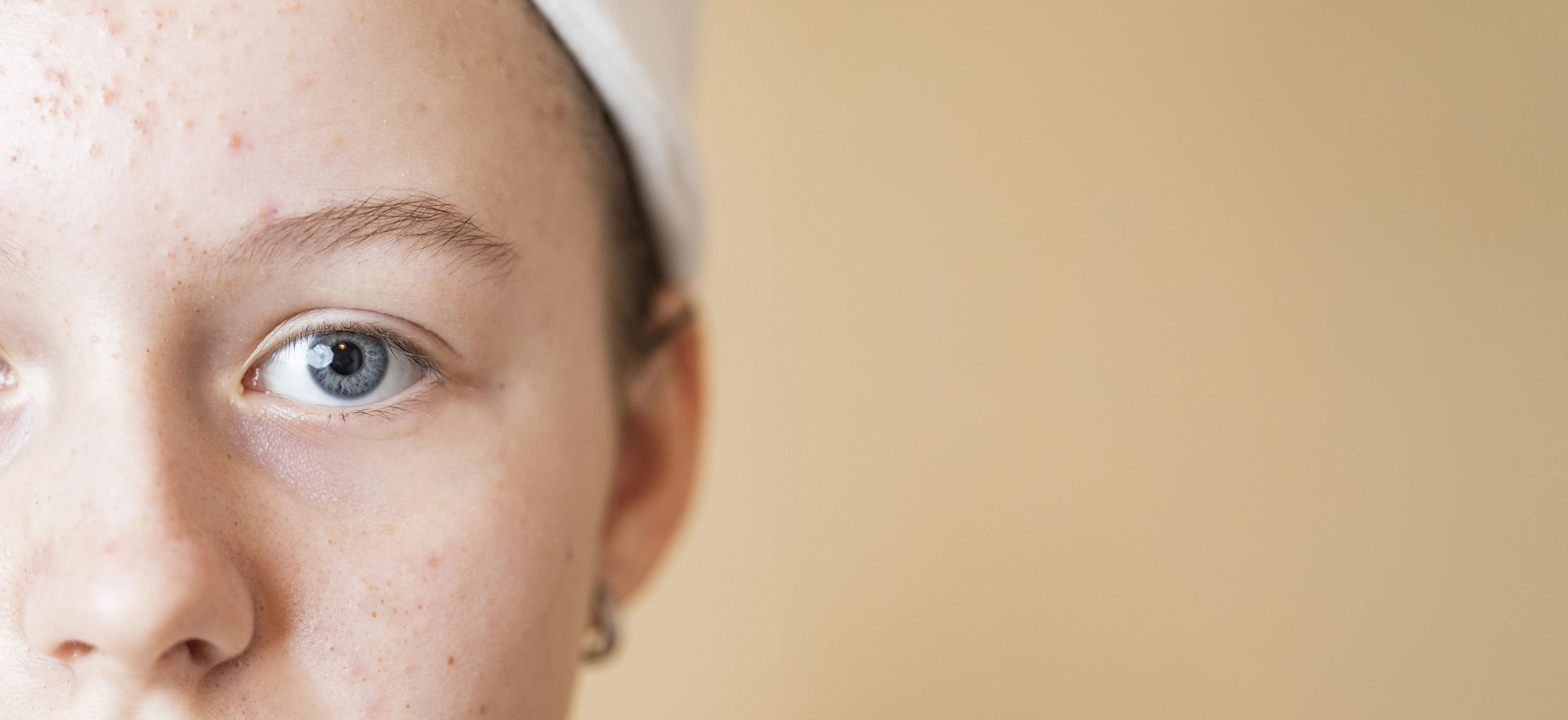 Teen girl with acne problem - Hormonal Acne - A Complete Guide - Palm Beach Dermatology Group - PGA Dermatology