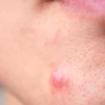 Cystic Acne - Causes, Symptoms & Treatment