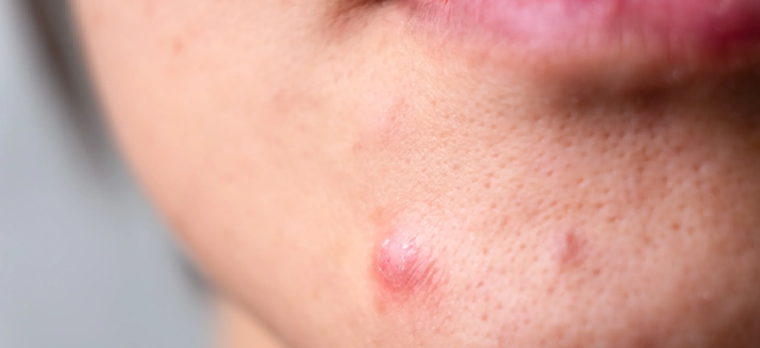 Cystic Acne - Causes, Symptoms & Treatment