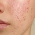 Teenage girl with acne problem on beige background, closeup - How To Get Rid of Cystic Acne? - Palm Beach Dermatology Group