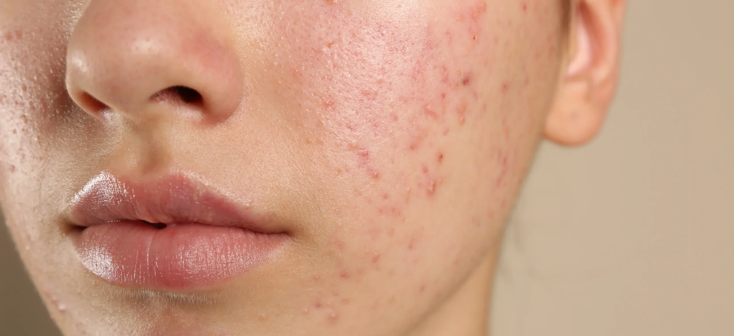 Teenage girl with acne problem on beige background, closeup - How To Get Rid of Cystic Acne? - Palm Beach Dermatology Group