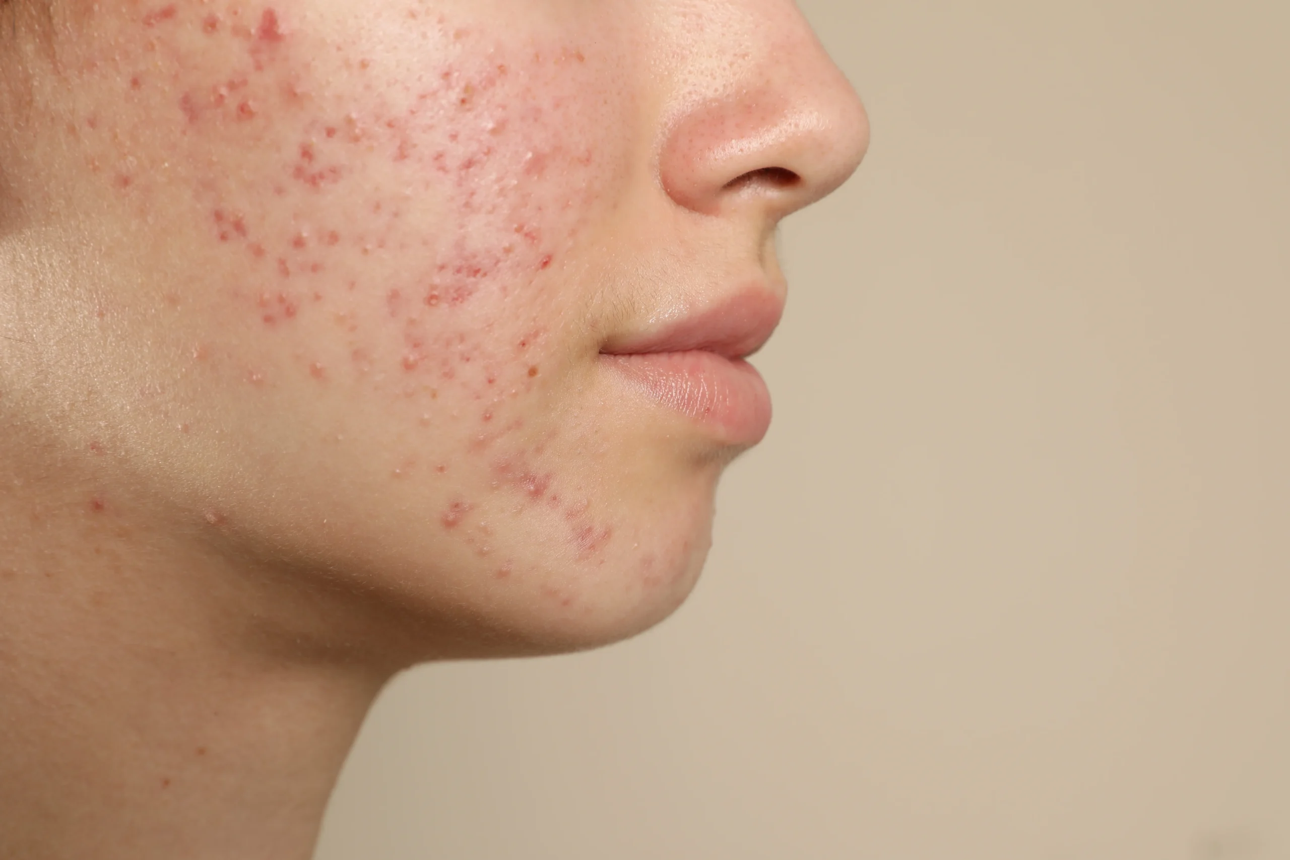 Cystic Acne - Causes, Symptoms & Treatment