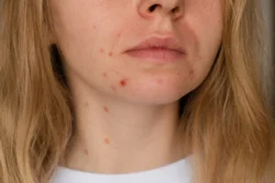 Cystic Acne - Causes, Symptoms & Treatment