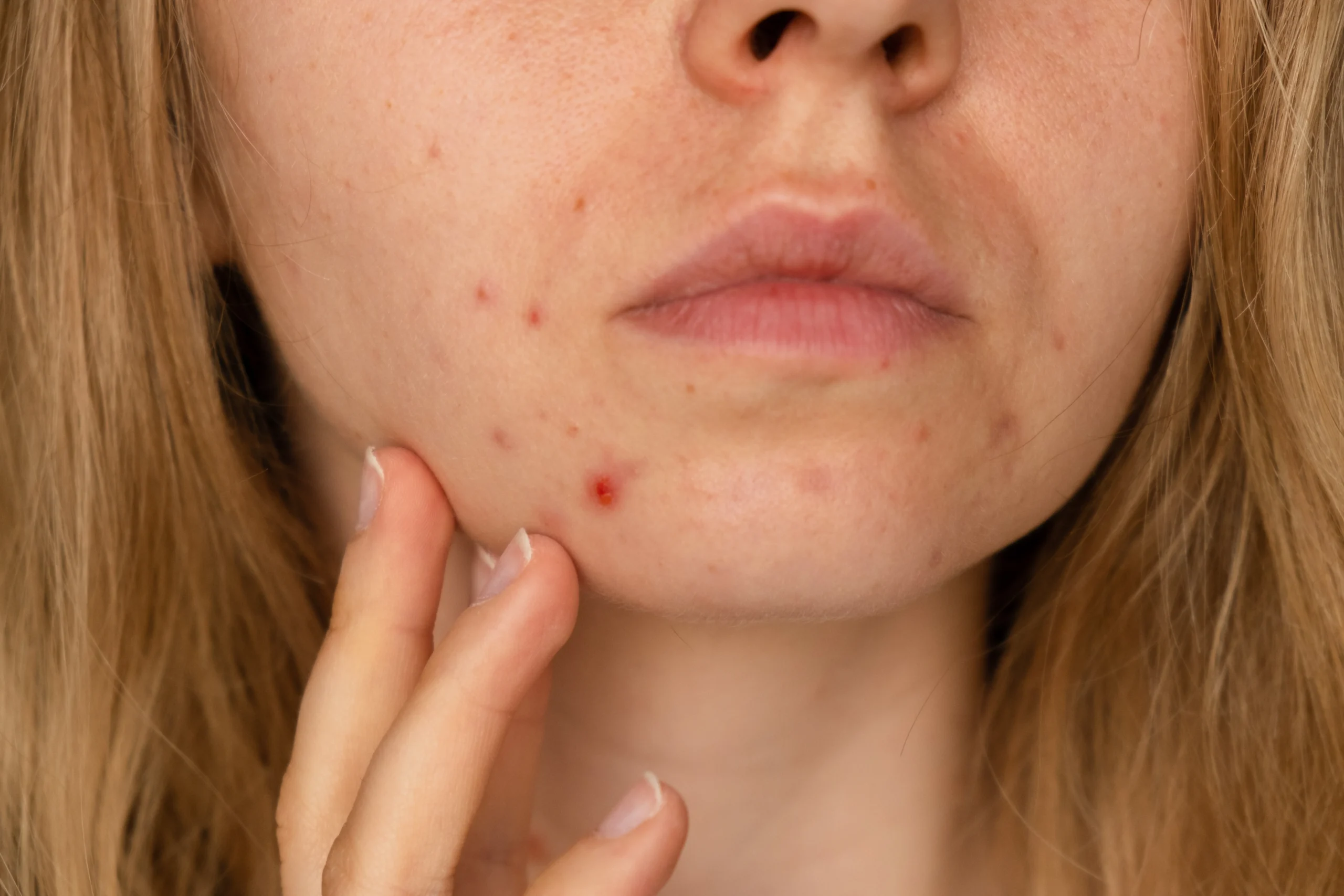 Unrecognizable woman showing her acne on face - What Causes Cystic Acne? - Palm Beach Dermatology Gruop