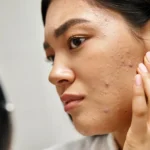 Young asian woman with brunwtte hair and pimples - What Causes Cystic Acne? - Palm Beach Dermatology Gruop
