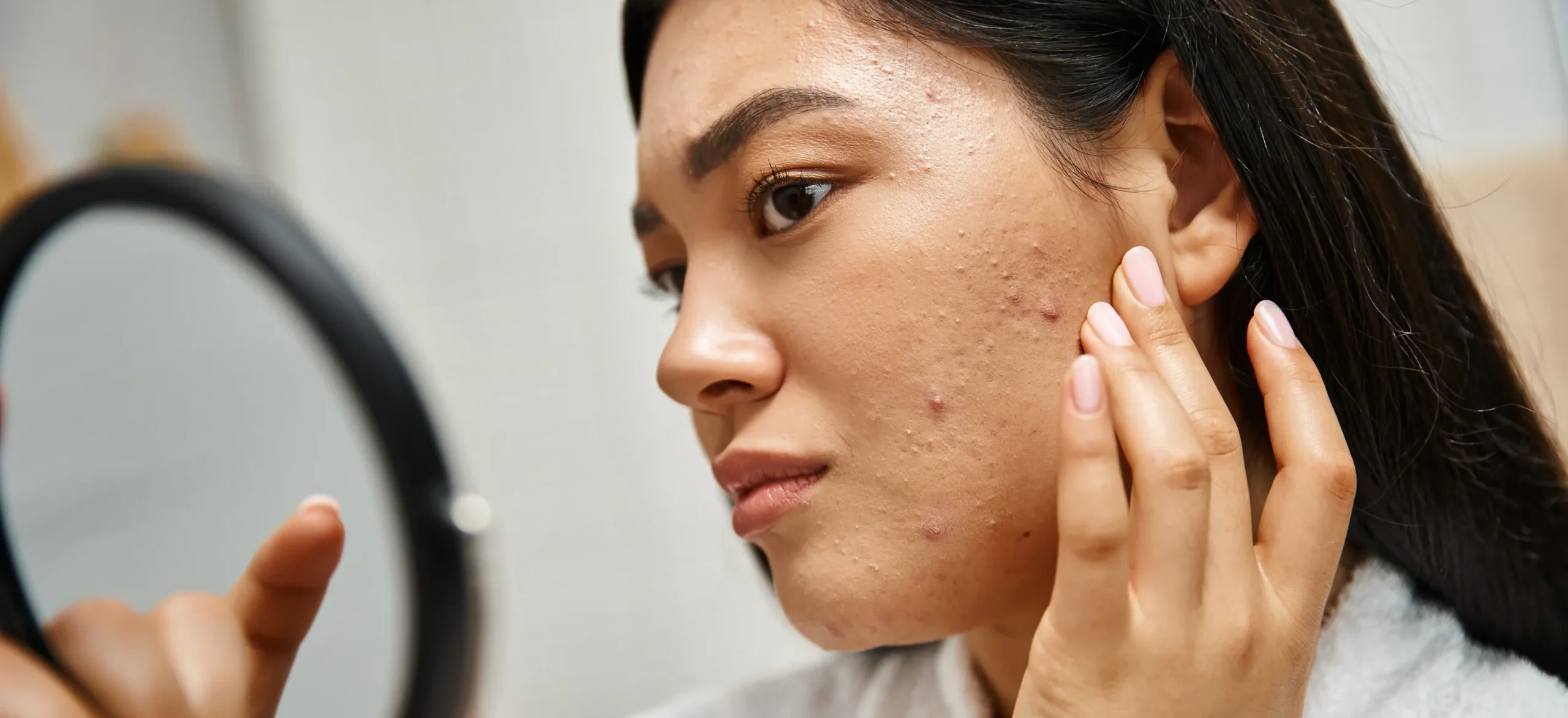 Young asian woman with brunwtte hair and pimples - What Causes Cystic Acne? - Palm Beach Dermatology Gruop