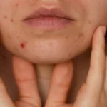 Unrecognizable woman showing her acne on face. Banner Close-up acne on woman's face with rash skin - How Long Does Cystic Acne Last? A Simple Guide