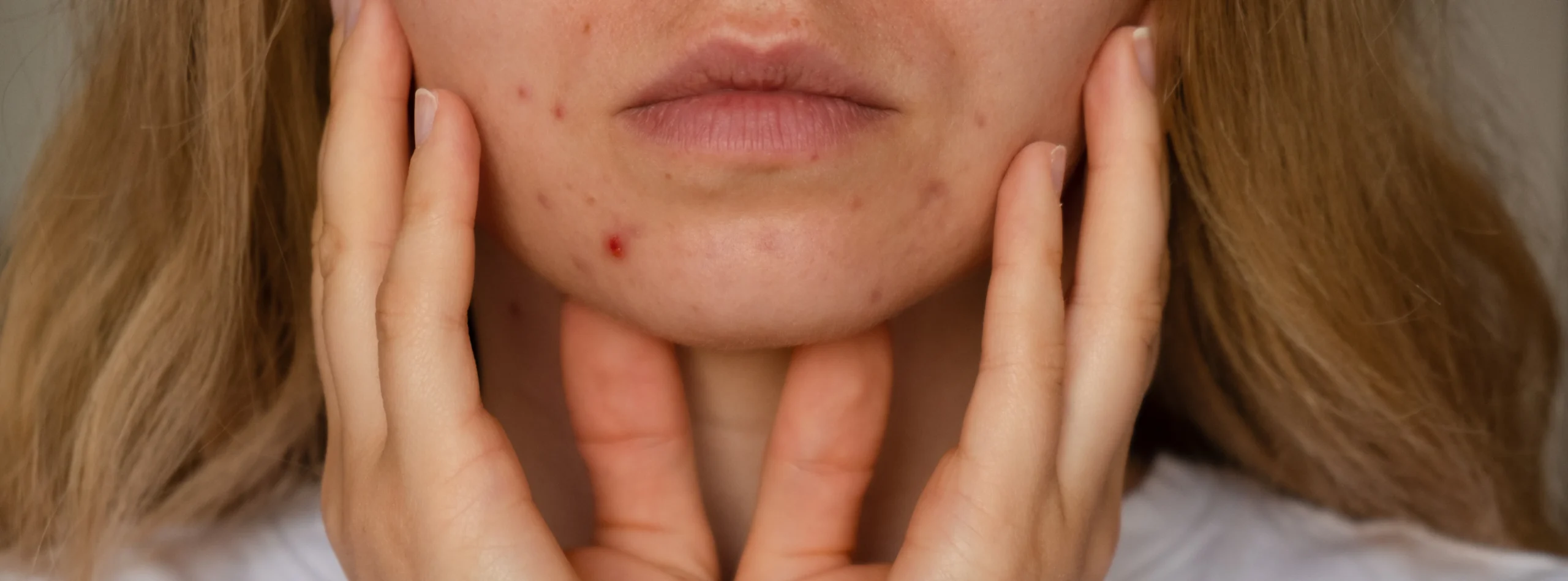 Unrecognizable woman showing her acne on face. Banner Close-up acne on woman's face with rash skin - How Long Does Cystic Acne Last? A Simple Guide