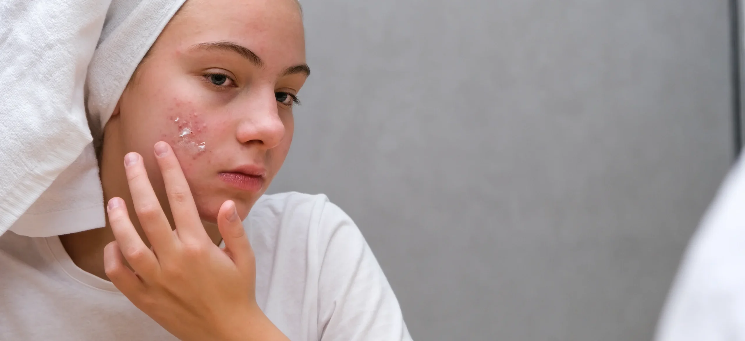 acne teenage girl applying acne medication her face front mirror care problem skin - Does Dairy Cause Acne? Causes, Signs & Prevention - Palm Beach Dermatology Group