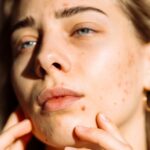 Does Coffee Cause Acne