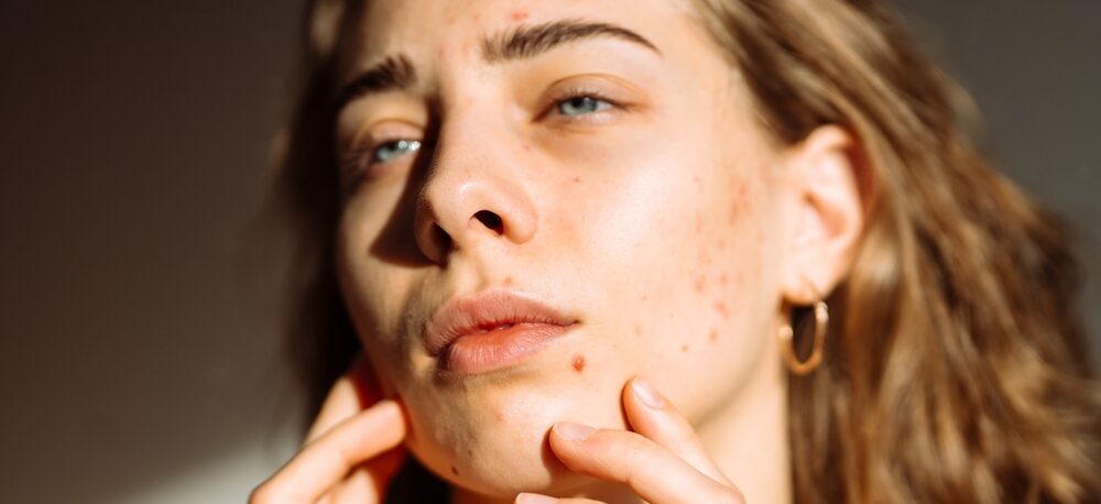 Does Coffee Cause Acne