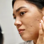 young asian woman with brunette hair and pimples - Does Stress Cause Acne? Signs, Tips & Myths - Palm Beach Dermatology Group