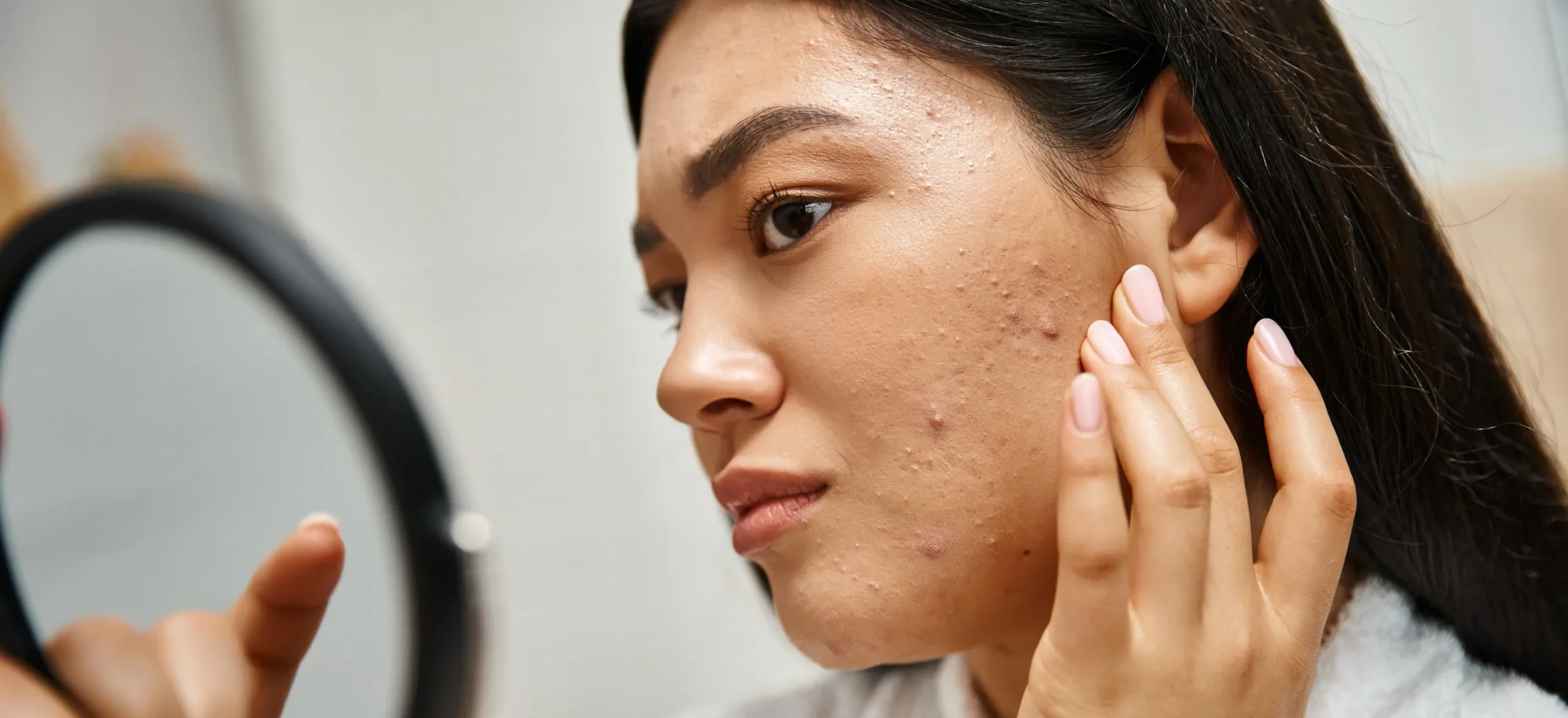young asian woman with brunette hair and pimples - Does Stress Cause Acne? Signs, Tips & Myths - Palm Beach Dermatology Group