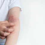 Child scratches itchy arm in studio setting - Is Eczema Hereditary? - Palm Beach Dermatology Group