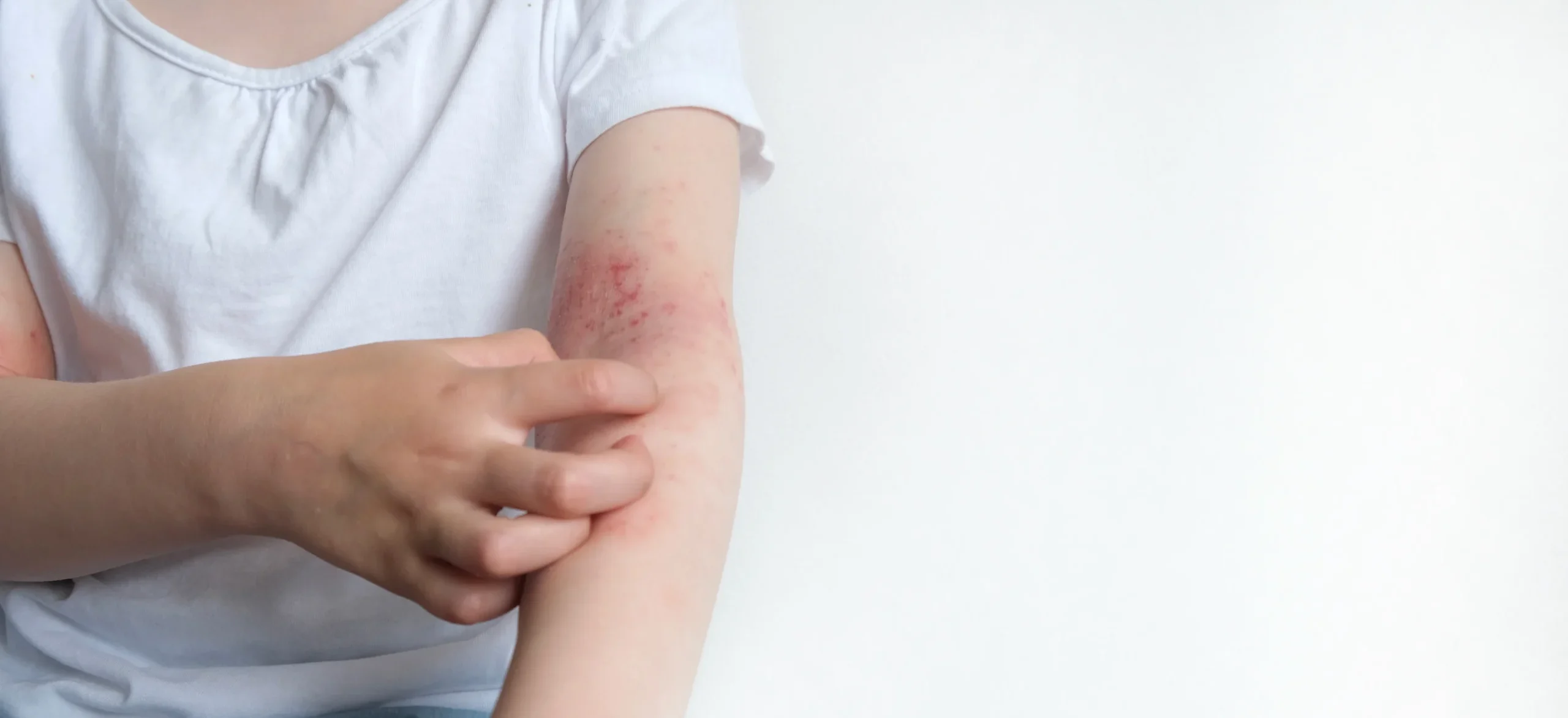 Child scratches itchy arm in studio setting - Is Eczema Hereditary? - Palm Beach Dermatology Group