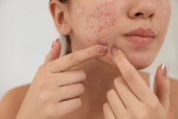close up of womans face with acne - Does Accutane Help Hormonal Acne?