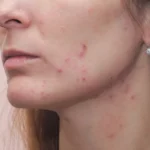 close up of woman face with skin imperfections - How to Treat Hormonal Acne? A Complete Step by Step Guide - Palm Beach Dermatology Group