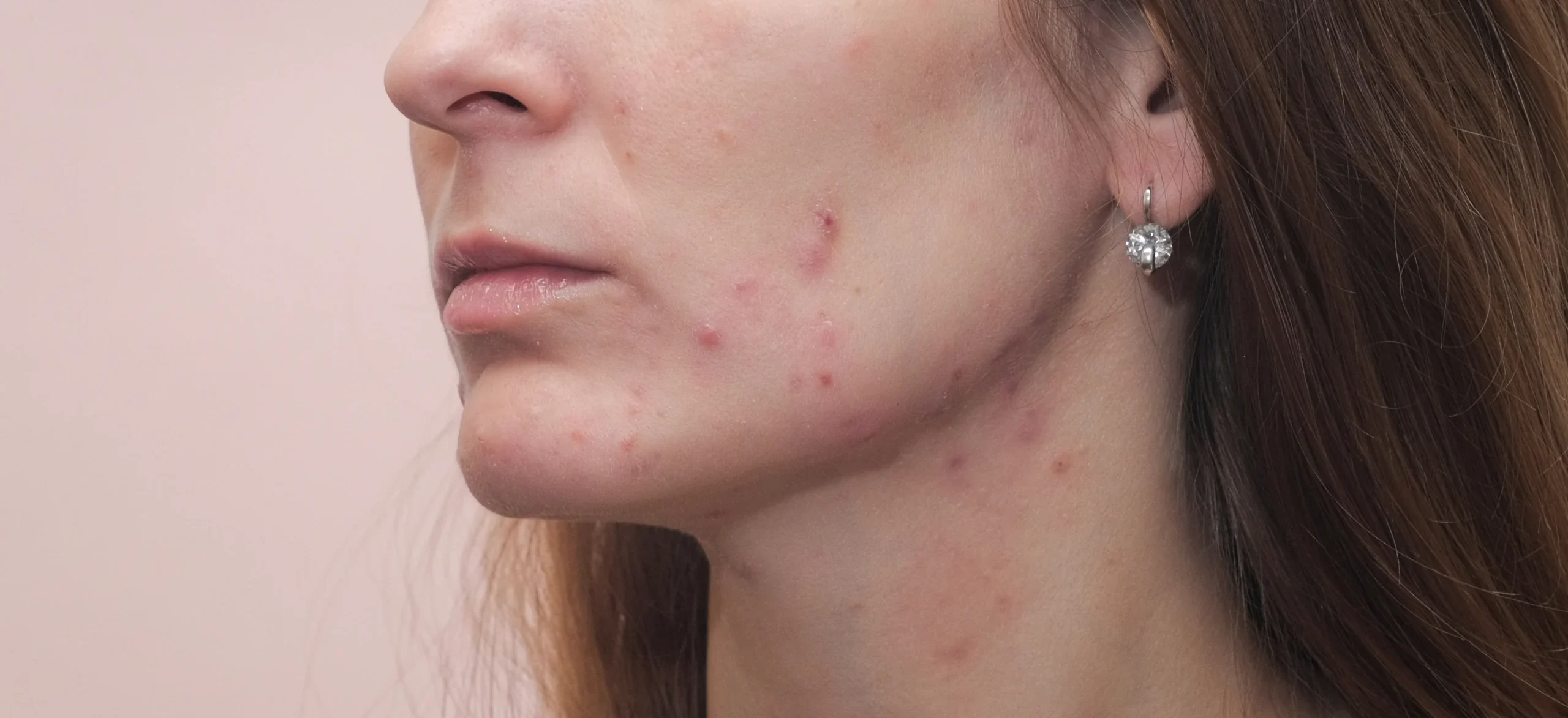 close up of woman face with skin imperfections - How to Treat Hormonal Acne? A Complete Step by Step Guide - Palm Beach Dermatology Group