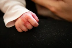 infant hand with red marks on black fabric - Is Eczema Hereditary? - Palm Beach Dermatology Group