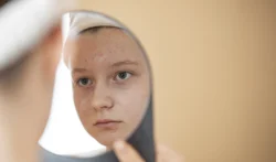 teen looks in mirror at face - Does Accutane Help Hormonal Acne?