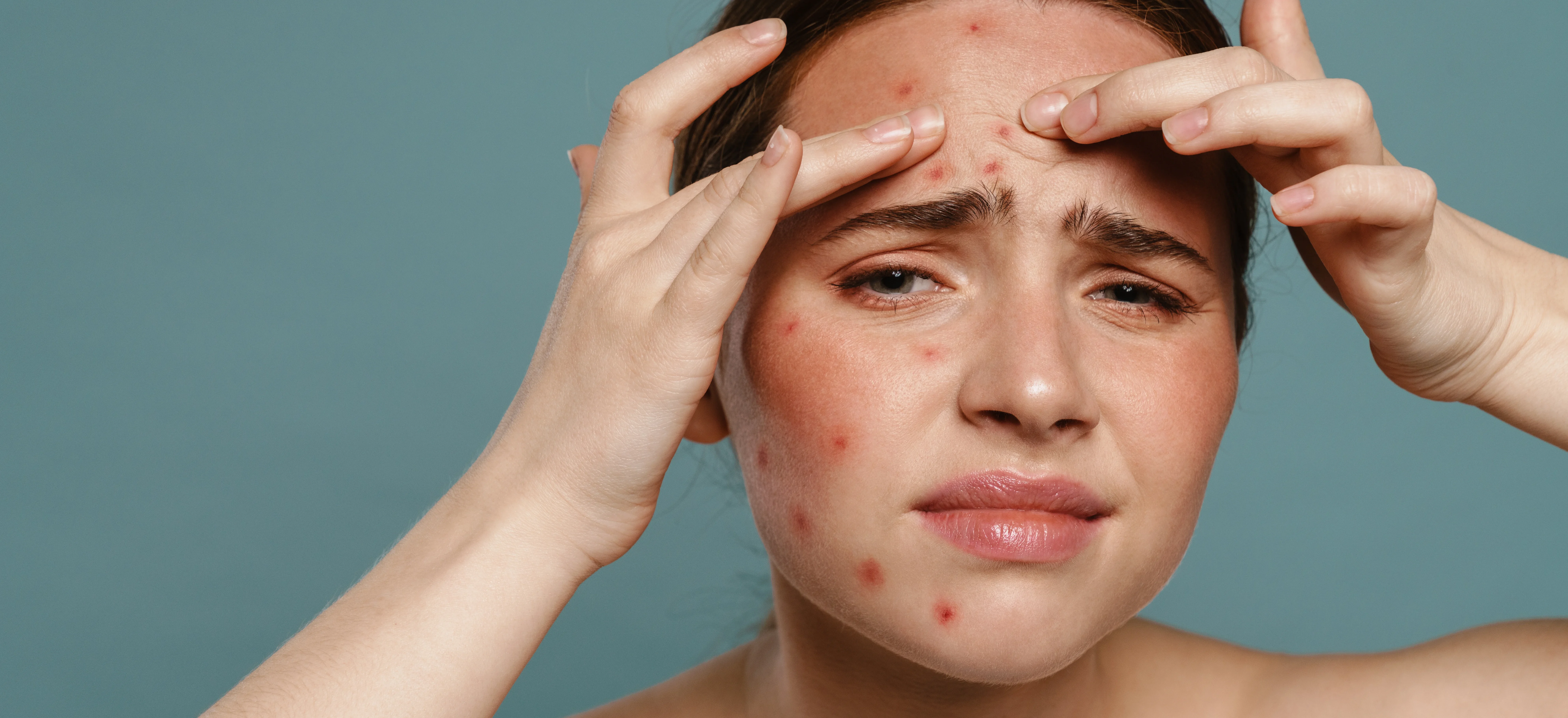 young woman addressing blemishes in studio - Does Accutane Help Hormonal Acne?
