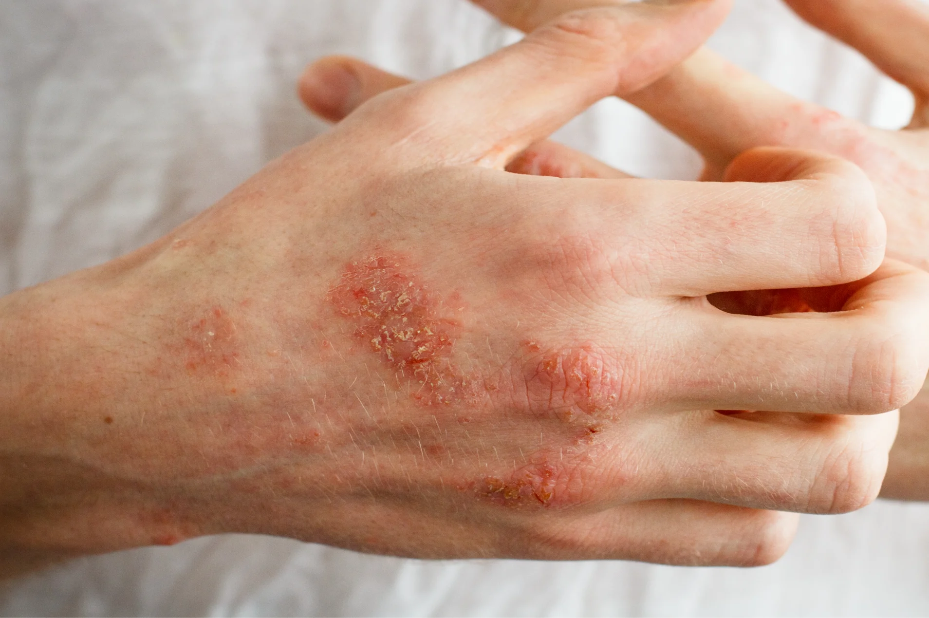 What Is Eczema and What Causes It?