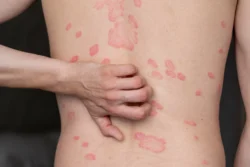 adult scratching psoriasis on back in studio - Psoriasis vs Eczema: Understanding the Key Differences