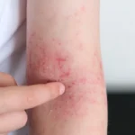 arm with red rash and irritation in studio - Psoriasis vs Eczema: Understanding the Key Differences